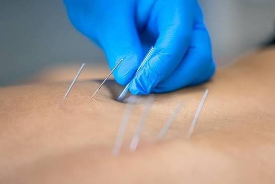 Clinical dry needling treatment